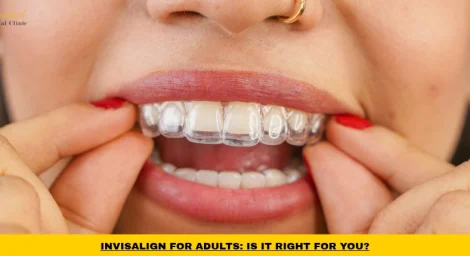 Adult wearing clear aligners for Invisalign for adults treatment