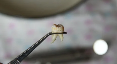 Learn about root canal recovery time, healing timeline, and a real wisdom tooth extraction story from Vancouver’s trusted dentist, Dr. Alavi.