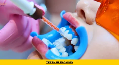 Professional teeth bleaching treatment in Vancouver using dentist-supervised peroxide whitening