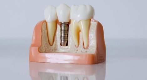 Affordable Dental Implant Surgery in Vancouver