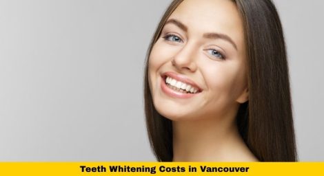 Teeth Whitening Costs in Vancouver