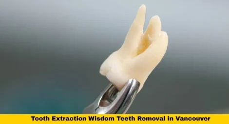 Tooth Extraction Wisdom Teeth Removal in Vancouver