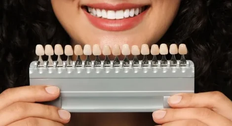 Close-up of woman holding veneer shade guide showing different tooth colors — how much are veneers in BC
