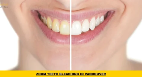 Zoom teeth bleaching treatment in Vancouver using Philips professional whitening system