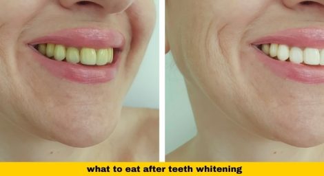 What to Eat After Teeth Whitening (White Diet Guide for Vancouver)​